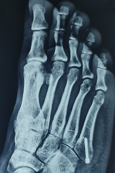 After X-ray
