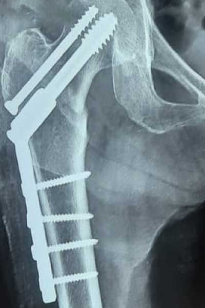 After X-ray