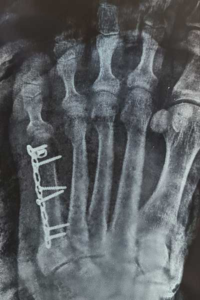 After X-ray