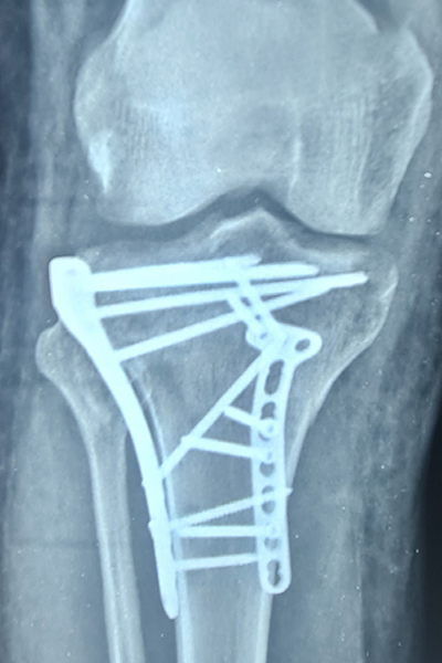 After X-ray