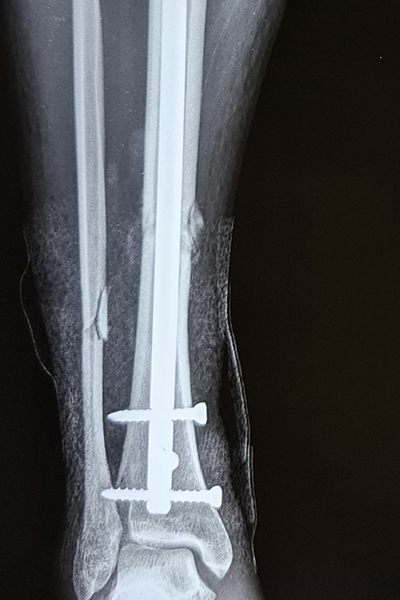 After X-ray