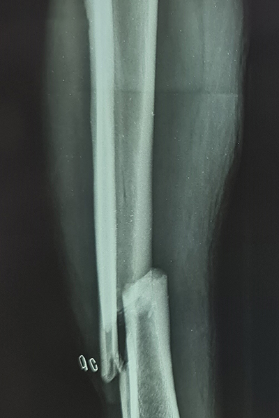 Before X-ray